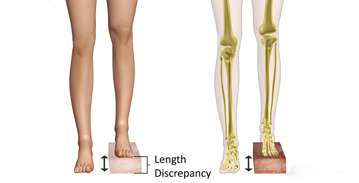leg length discrepancy